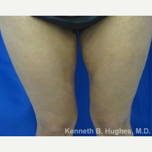 Liposuction before 3094225
