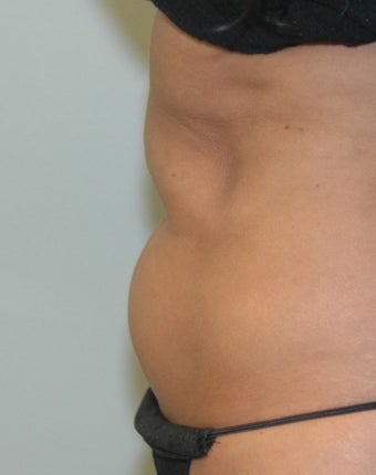 38 Year Old Female for CoolSculpting before 1393854