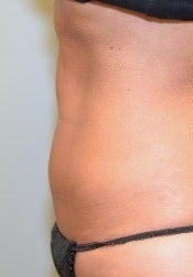 38 Year Old Female for CoolSculpting after 1393854