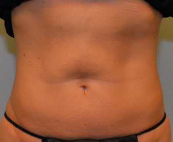 38 Year Old Female for CoolSculpting 1393854