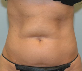 38 Year Old Female for CoolSculpting 1393854