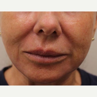 55-64 year old woman treated with CO2 Laser after 1907115