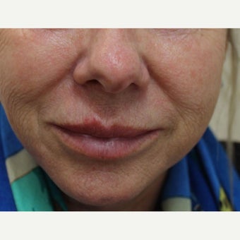 55-64 year old woman treated with CO2 Laser before 1907115