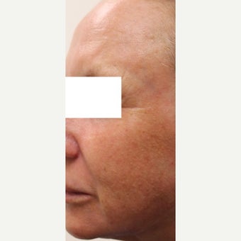 55-64 year old woman treated with CO2 Laser 1907115