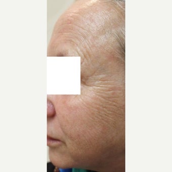 55-64 year old woman treated with CO2 Laser 1907115