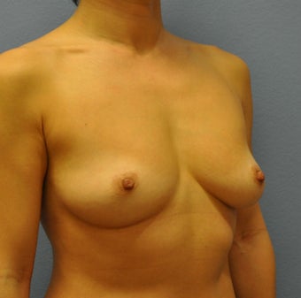 Breast Augmentation, Breast Implants 1083028