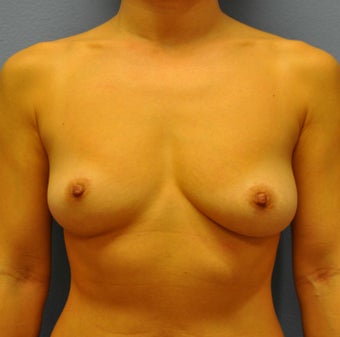 Breast Augmentation, Breast Implants before 1083028