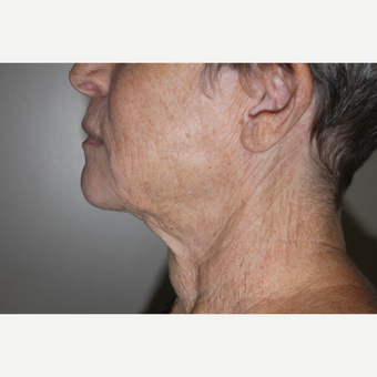 65-74 year old woman treated with Smart Lipo to the neck after 2994424
