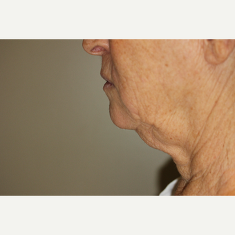 65-74 year old woman treated with Smart Lipo to the neck before 2994424