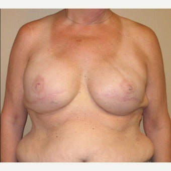 65-74 year old woman treated with Breast Reconstruction after 2026089