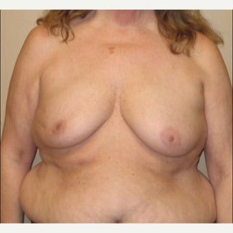 65-74 year old woman treated with Breast Reconstruction before 2026089