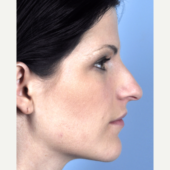 25-34 year old woman treated with Rhinoplasty before 3815704