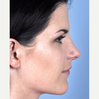 25-34 year old woman treated with Rhinoplasty after 3815704