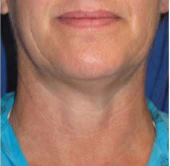 35-44 year old woman treated with Velashape before 1580372