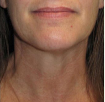 35-44 year old woman treated with Velashape after 1580372