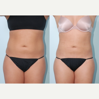 35-44 year old woman treated with Body Jet before 3642453