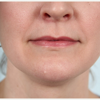 25-34 year old female who had a mole removed from her chin before 3212142