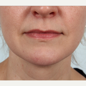 25-34 year old female who had a mole removed from her chin after 3212142