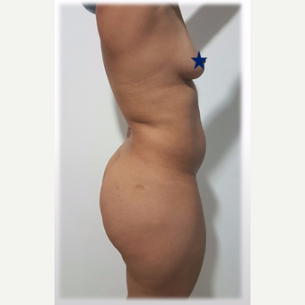 25-34 year old woman treated with Brazilian Butt Lift before 3288212