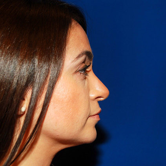 Chin Augmentation after 944865