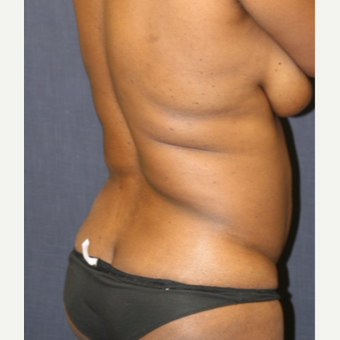 43 year old woman treated with Butt Augmentation before 3663927