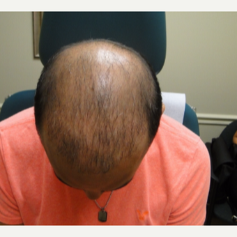 25-34 year old hispanic male patient treated with PRP for Hair Loss after 3195559