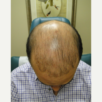 25-34 year old hispanic male patient treated with PRP for Hair Loss before 3195559