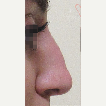 25-34 year old woman treated with Non Surgical Nose Job before 3216739