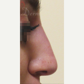 25-34 year old woman treated with Non Surgical Nose Job after 3216739