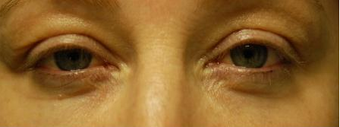 Madonna Lift one week after Smartskin for upper and lower lid wrinkles before 649077