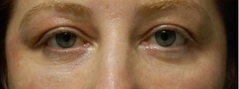 Madonna Lift one week after Smartskin for upper and lower lid wrinkles after 649077