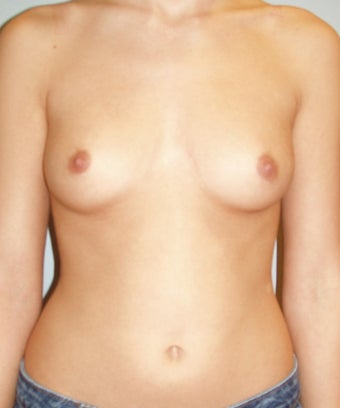 23 year old breast augmentation with silicone implants A to full C before 885908
