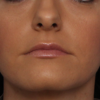 25-34 year old woman treated with Lip Augmentation before 3577689