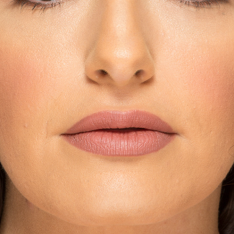25-34 year old woman treated with Lip Augmentation after 3577689