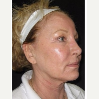 55-64 year old woman treated with Non Surgical Face Lift before 3181400