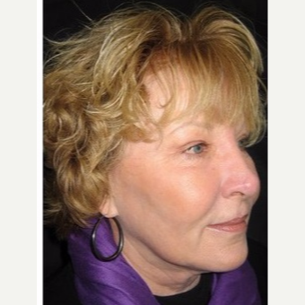55-64 year old woman treated with Non Surgical Face Lift after 3181400