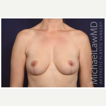 35-44 year old woman treated with Breast Lift after 3103444