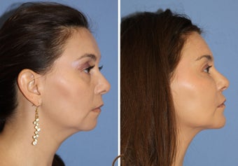Fat transfer performed under local anesthesia 1466872