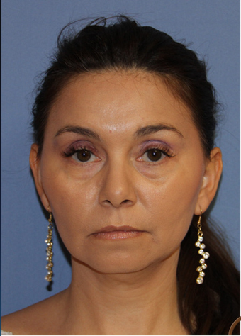 Fat transfer performed under local anesthesia before 1466872
