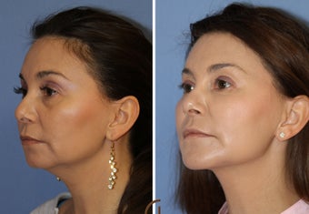 Fat transfer performed under local anesthesia 1466872