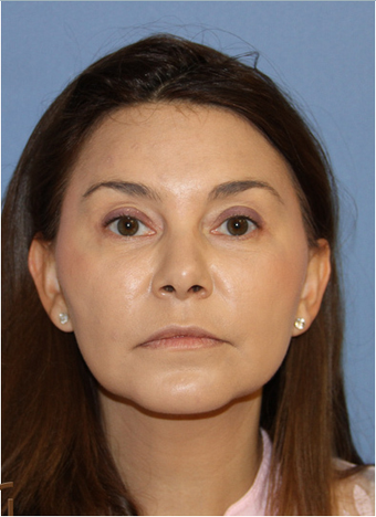 Fat transfer performed under local anesthesia after 1466872