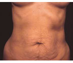 Mommy Makeover Tummy Tuck before 408770