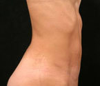 Mommy Makeover Tummy Tuck 408770