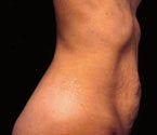Mommy Makeover Tummy Tuck 408770