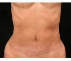 Mommy Makeover Tummy Tuck after 408770