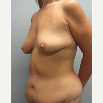 38 year old woman treated with Mommy Makeover before 3468535