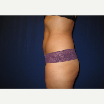 35-44 year old woman treated with Smart Lipo after 3803990