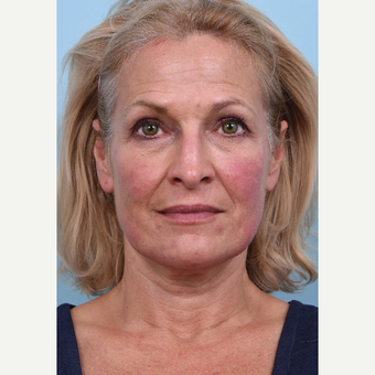 55 year old woman treated with Liquid Facelift before 3610767