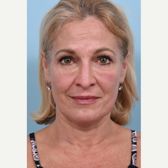 55 year old woman treated with Liquid Facelift after 3610767