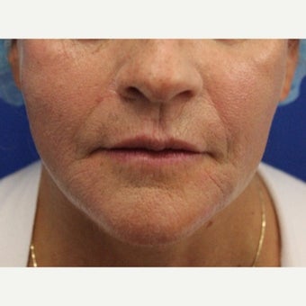 59 year old woman treated with Bellafill for volume loss to mid face after 2120599